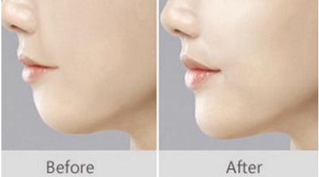 上海唇裂修復(fù)的五家知名醫(yī)院，人氣爆棚，不容錯過！