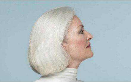 湖州98醫(yī)院面部脂肪填充案例分享，顛覆傳統(tǒng)整形方法