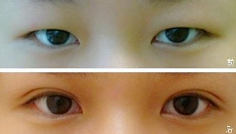 塑造完美鼻型，一觸即達！隆鼻醫(yī)生品牌推薦，成功案例揭秘，費用一覽表震撼來襲