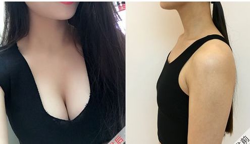 安醫(yī)大一附院整形外科推薦醫(yī)生，自體脂肪隆胸效果好