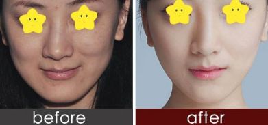 有效消腫的雙眼皮修復技巧由經(jīng)驗豐富的整形醫(yī)生分享