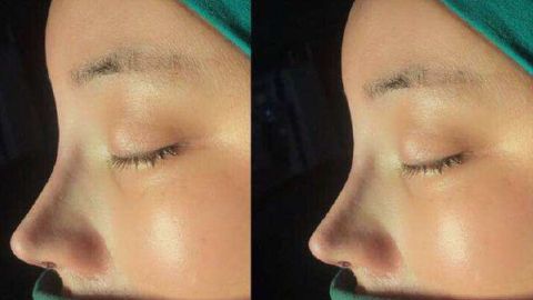 最佳2023西安雙眼皮修復醫(yī)生推薦！宋保強、馬顯杰好評如潮，立即預約！