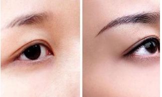 北京田永成醫(yī)美隆胸價格及術(shù)后效果解析