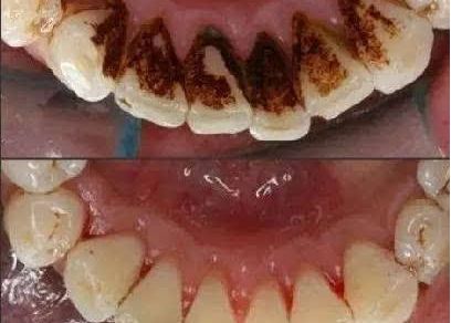 上海蝶可變整形醫(yī)院豐胸案例新鮮發(fā)布，引領(lǐng)時尚潮流