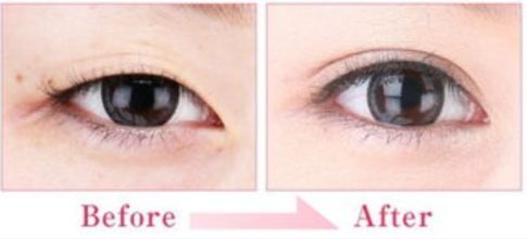 合肥哪家醫(yī)院的隆鼻效果好？技術(shù)過(guò)硬嗎？