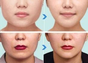 杭州哪家醫(yī)院做下頜角整形效果好？綜合口碑、價(jià)格受好評(píng)的幾家醫(yī)院推薦