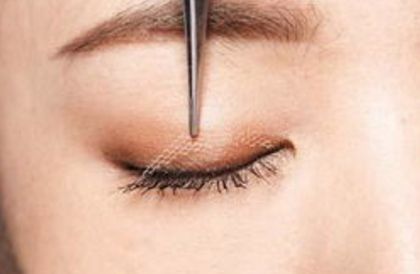 鄭州賈亮眼部整形技術(shù)介紹，修復(fù)雙眼皮效果如何？成功案例披露