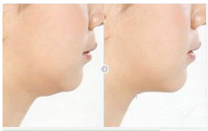 高偉的頜骨修復(fù)費(fèi)用及綜合實(shí)力揭秘，醫(yī)生專業(yè)解讀技術(shù)及真實(shí)案例分享