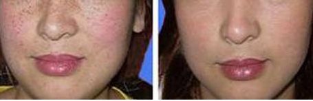 龍崗中心醫(yī)院整形科的雙眼皮修復(fù)醫(yī)生怎么樣？