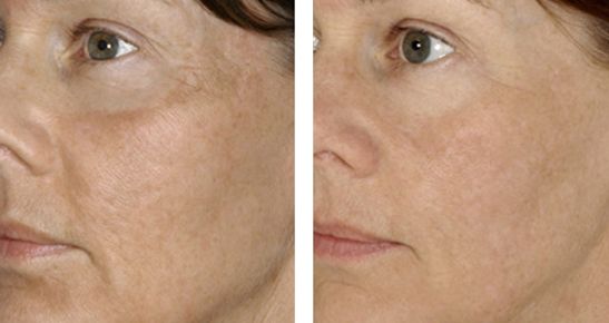 北京下頜角修復(fù)專家推薦，張笑天助您實(shí)現(xiàn)理想瘦臉！