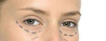 重慶德龍整形醫(yī)院推出先進技術，助您實現(xiàn)完美雙眼皮!