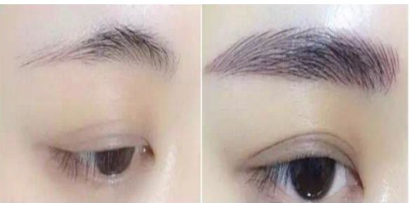 專家為您解答：涿州市哪家醫(yī)院可進(jìn)行瘦臉針治療？費(fèi)用如何？醫(yī)師推薦為參考