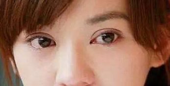 探索成都圣丹福整形醫(yī)院的雙眼皮修復成果，經(jīng)驗分享