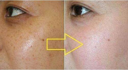 杭州哪家醫(yī)院是比較好的隆鼻選擇？