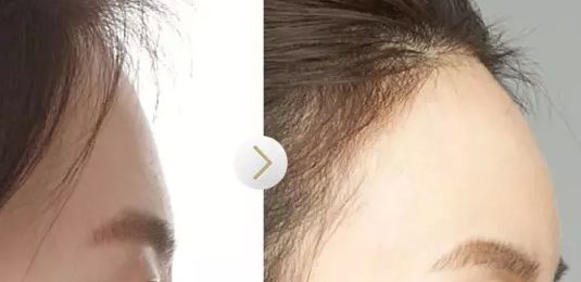 廣州顏玲診所最新出爐吸脂技術(shù)效果如何？該醫(yī)院案例曝光