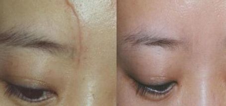 杭州一位醫(yī)生的雙眼皮手術(shù)實(shí)踐分享，持續(xù)80天的親身經(jīng)歷！