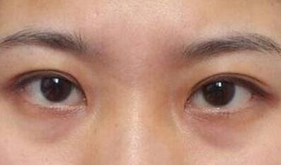 杭州東方整形吸脂到底值不值得嘗試？