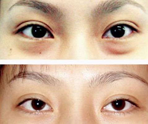 謝錦清：醫(yī)術高超，雙眼皮案例解析曝光！