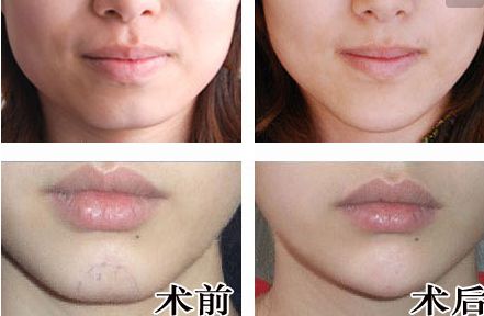 廣州人中縮短手術(shù)醫(yī)生推薦？網(wǎng)友真實(shí)評(píng)價(jià)與信息公開！