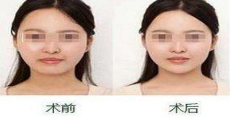 揚(yáng)州隆胸專家2024榜單評(píng)選揭曉：挑選胸部整形領(lǐng)域翹楚！