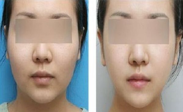 廣州上眼皮下垂匹配專業(yè)矯正整形醫(yī)院