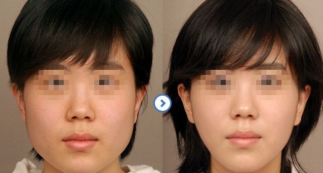 成都隆鼻醫(yī)生排行榜2024：專家推薦的醫(yī)院大揭秘！