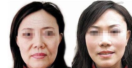 成都自然雙眼皮去哪家醫(yī)院靠譜？