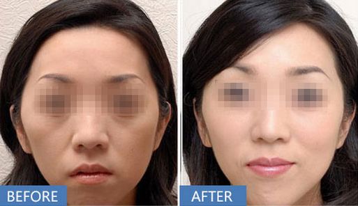 上海哪家醫(yī)院做打玻尿酸除皺效果好？