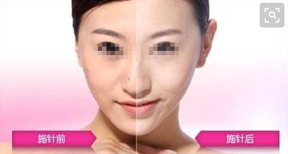 廣州哪家醫(yī)院可以安全進行拉皮手術(shù)？