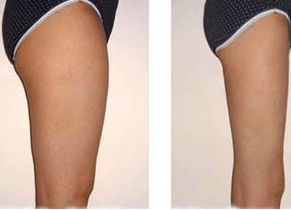 廣州荔灣人民醫(yī)院植發(fā)口碑評價及費用參考