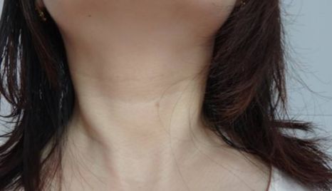 無錫臥蠶手術(shù)哪家醫(yī)院做得好？江南大學(xué)附屬醫(yī)院高鳳山，整形外科主任醫(yī)師給您解答