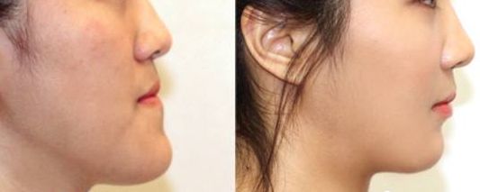 南京施爾美醫(yī)院醫(yī)生案例對(duì)比，讓你信服！