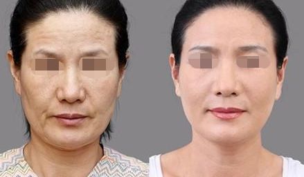 雍禾與碧蓮盛技術(shù)優(yōu)勢(shì)與收費(fèi)比較