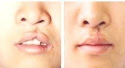 南昌割雙眼皮口碑醫(yī)院大盤點(diǎn)！這3家備受推崇