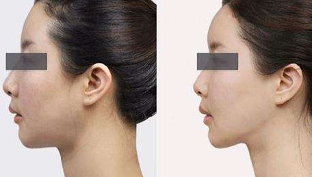 2024上海超聲炮口碑醫(yī)院人氣榜前五  價(jià)格一覽