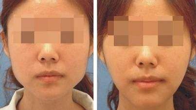 上海哪家醫(yī)院的下巴隆鼻手術(shù)效果最好？