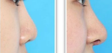 韓佳人是否接受過(guò)整容手術(shù)？探尋演藝之路的變遷