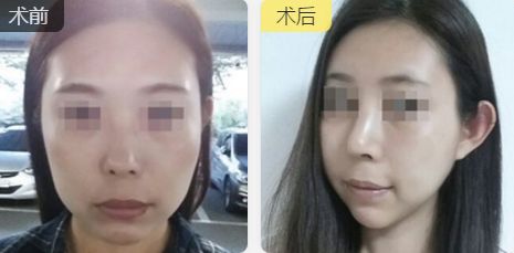 合肥雙眼皮整形推薦：口碑好、技術(shù)精湛、性價(jià)比高的醫(yī)生