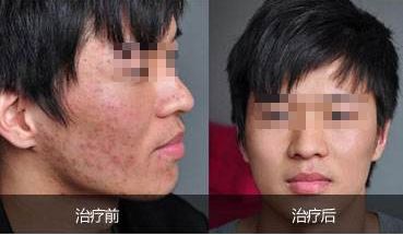 重慶吸脂哪家好？華美吸脂專家經(jīng)驗(yàn)豐富，安全保障