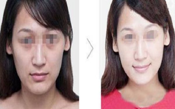 乳房重建手術(shù)有哪些選擇