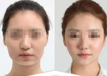 南寧市哪家醫(yī)院做雙眼皮好？