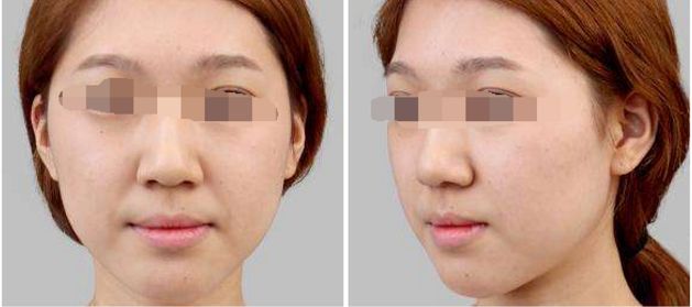 成都隆胸手術(shù)費用及醫(yī)院選擇指南(2024最新)