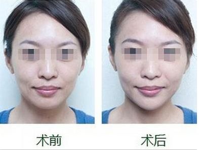 成都更受歡迎的脂肪填充技術(shù)推薦