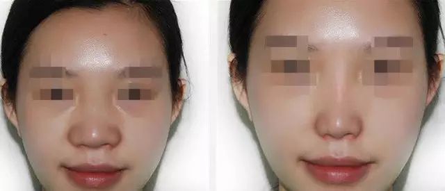 哈爾濱哪家醫(yī)院做隆鼻好？醫(yī)療技術(shù)排行幫你快速選擇