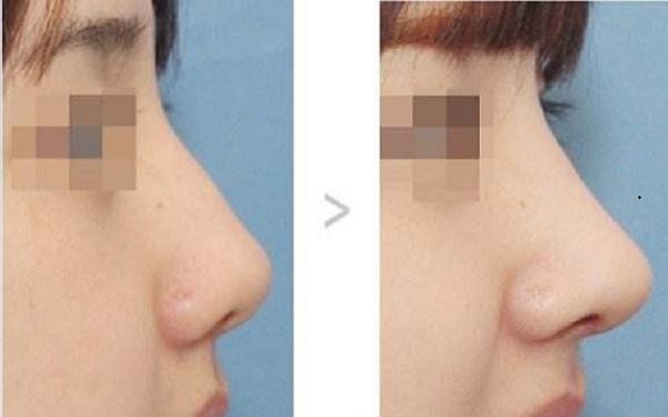 青島哪家下頜角整形醫(yī)院口碑好？