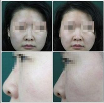 長(zhǎng)春銘醫(yī)整形醫(yī)院雙眼皮手術(shù)效果及費(fèi)用查詢(xún)