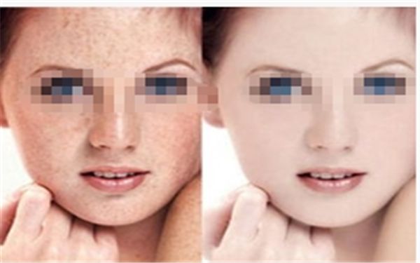 合肥哪家醫(yī)院近視激光手術(shù)靠譜？