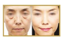 日照哪家醫(yī)院做雙眼皮手術(shù)技術(shù)高效？