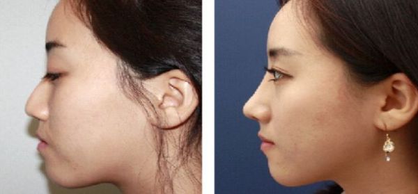 北京大腿抽脂專家推薦，哪個醫(yī)院技術(shù)好？