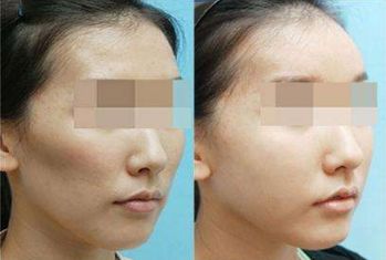 合肥哪兒可以做有效果的光子嫩膚？